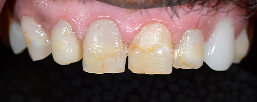 Close Up Smiles Before Image 32 - Walden Dental