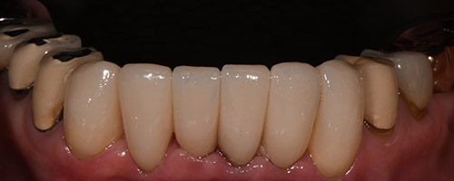 Close Up Smiles After Image 33 - Walden Dental