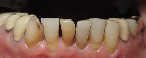 Close Up Smiles Before Image 33 - Walden Dental