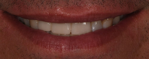 Close Up Smiles After Image 34 - Walden Dental