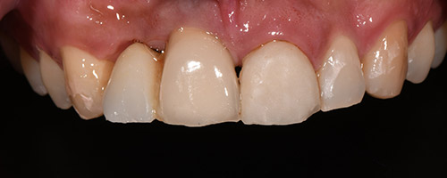Close Up Smiles Before Image 34 - Walden Dental