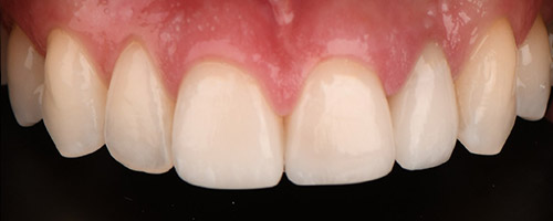 Close Up Smiles After Image 35 - Walden Dental