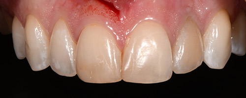 Close Up Smiles Before Image 35 - Walden Dental