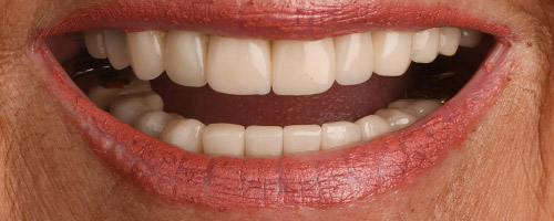 Close Up Smiles After Image 36 - Walden Dental
