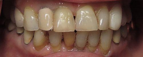 Close Up Smiles Before Image 36 - Walden Dental