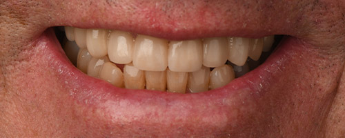 Close Up Smiles After Image 37 - Walden Dental