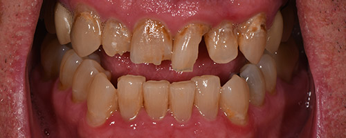 Close Up Smiles Before Image 37 - Walden Dental