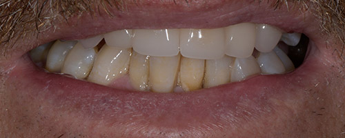 Close Up Smiles After Image 38 - Walden Dental