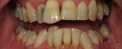 Close Up Smiles Before Image 38 - Walden Dental