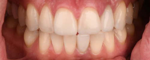 Close Up Smiles After Image 39 - Walden Dental