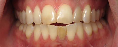 Close Up Smiles Before Image 39 - Walden Dental