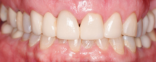 Close Up Smiles After Image 40 - Walden Dental