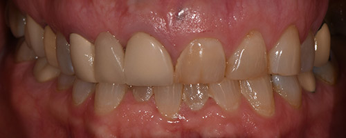 Close Up Smiles Before Image 40 - Walden Dental