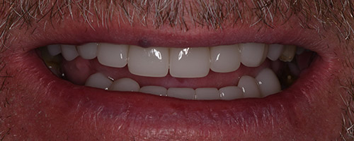 Close Up Smiles After Image 41 - Walden Dental