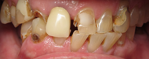 Close Up Smiles Before Image 41 - Walden Dental