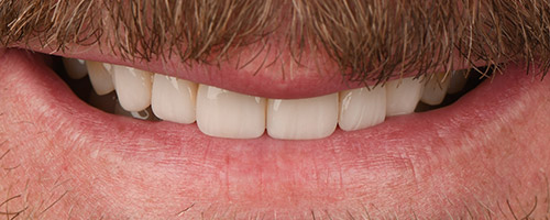 Close Up Smiles After Image 42 - Walden Dental