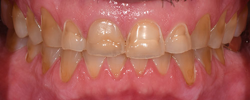 Close Up Smiles Before Image 42 - Walden Dental