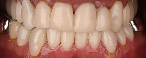 Close Up Smiles After Image 43 - Walden Dental