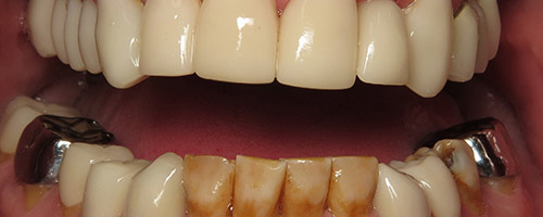 Close Up Smiles Before Image 43 - Walden Dental