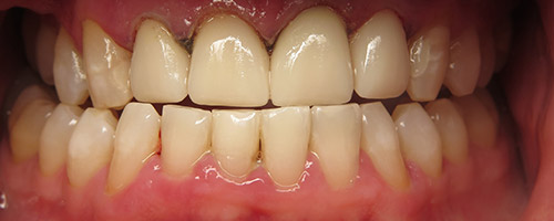 Close Up Smiles After Image 44 - Walden Dental