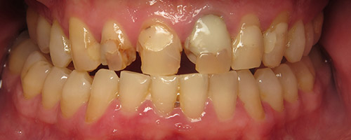 Close Up Smiles Before Image 44 - Walden Dental