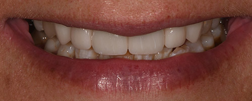 Close Up Smiles After Image 45 - Walden Dental