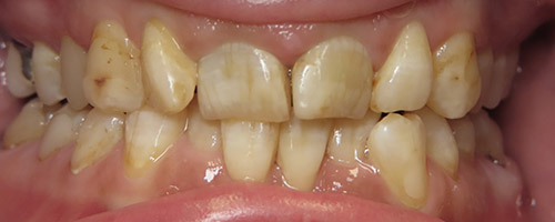 Close Up Smiles Before Image 45 - Walden Dental