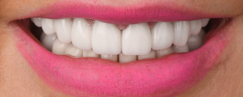Close Up Smiles After Image 5 - Walden Dental