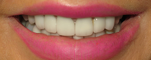 Close Up Smiles Before Image 5 - Walden Dental
