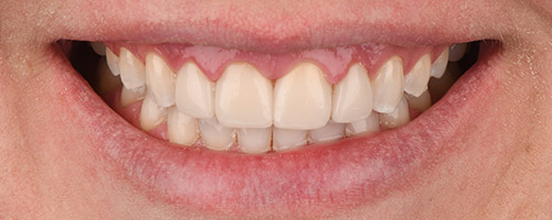 Close Up Smiles After Image 6 - Walden Dental