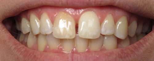 Close Up Smiles Before Image 5 - Walden Dental