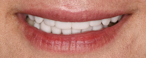 Close Up Smiles After Image 7 - Walden Dental