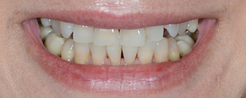 Close Up Smiles Before Image 7 - Walden Dental