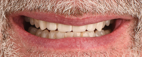 Close Up Smiles After Image 8 - Walden Dental