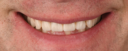 Close Up Smiles After Image 9 - Walden Dental