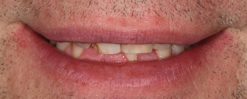Close Up Smiles Before Image 9 - Walden Dental