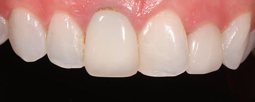 Before After images, Before Image-46 - Walden Dental
