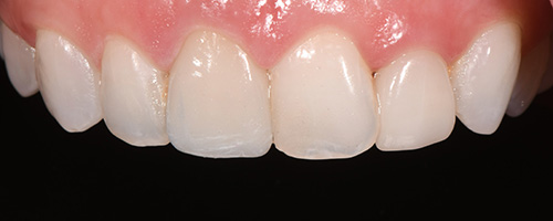 Before After images, After Image-46 - Walden Dental