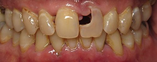 Before After images, Before Image-47 - Walden Dental