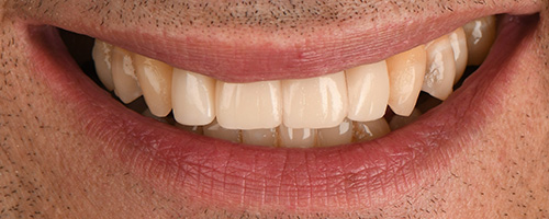 Before After images, After Image-47 - Walden Dental