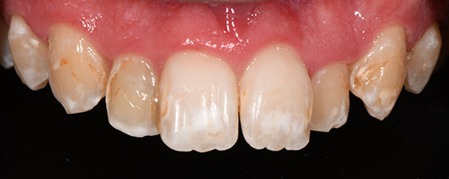 Before After images, Before Image-48 - Walden Dental