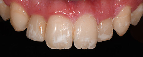 Before After images, After Image-48 - Walden Dental