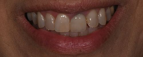 Before After images, Before Image-49 - Walden Dental