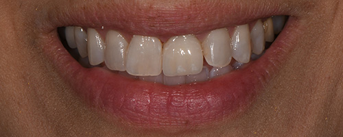 Before After images, After Image-49 - Walden Dental