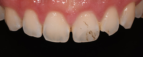 Before After images, Before Image-50 - Walden Dental