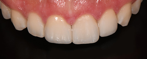 Before After images, After Image-50 - Walden Dental