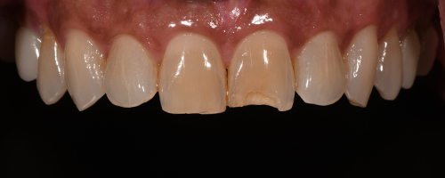 Before After images, Before Image-51 - Walden Dental
