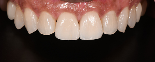 Before After images, Before Image-51 - Walden Dental