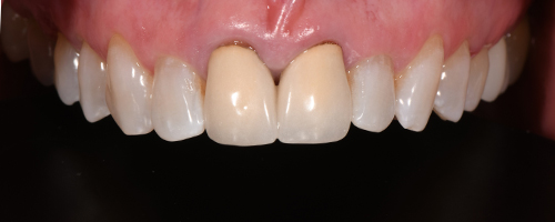 Before After images, Before Image-52 - Walden Dental