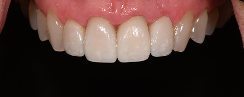 Before After images, Before Image-52 - Walden Dental